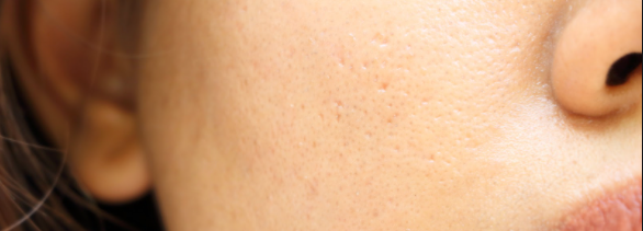 Enlarged Pores