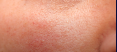 Flushing/Redness